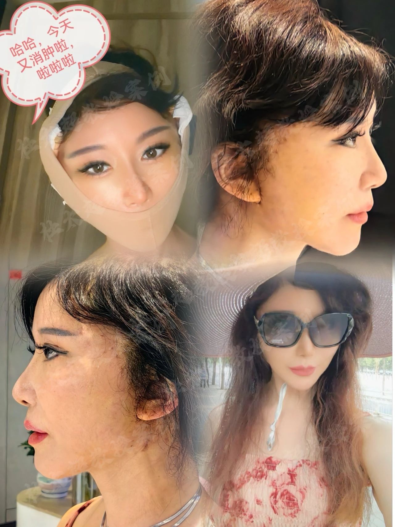 多大年龄能做拉皮？60岁处女座的青春逆袭，如何在细节中找回青春光芒！