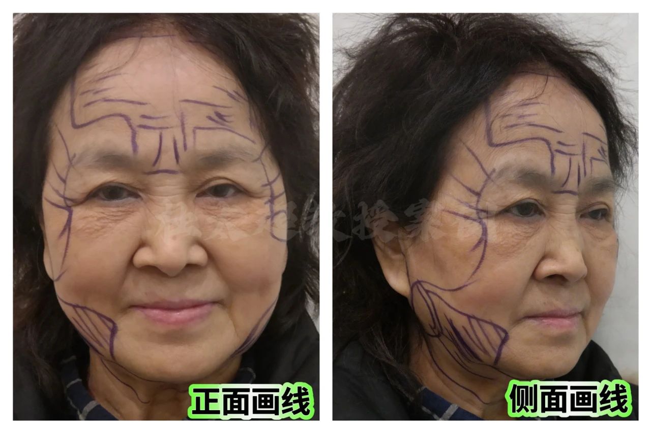 拉皮手术多大年龄适合做？惊呆了！70岁的一次青春重燃之旅！