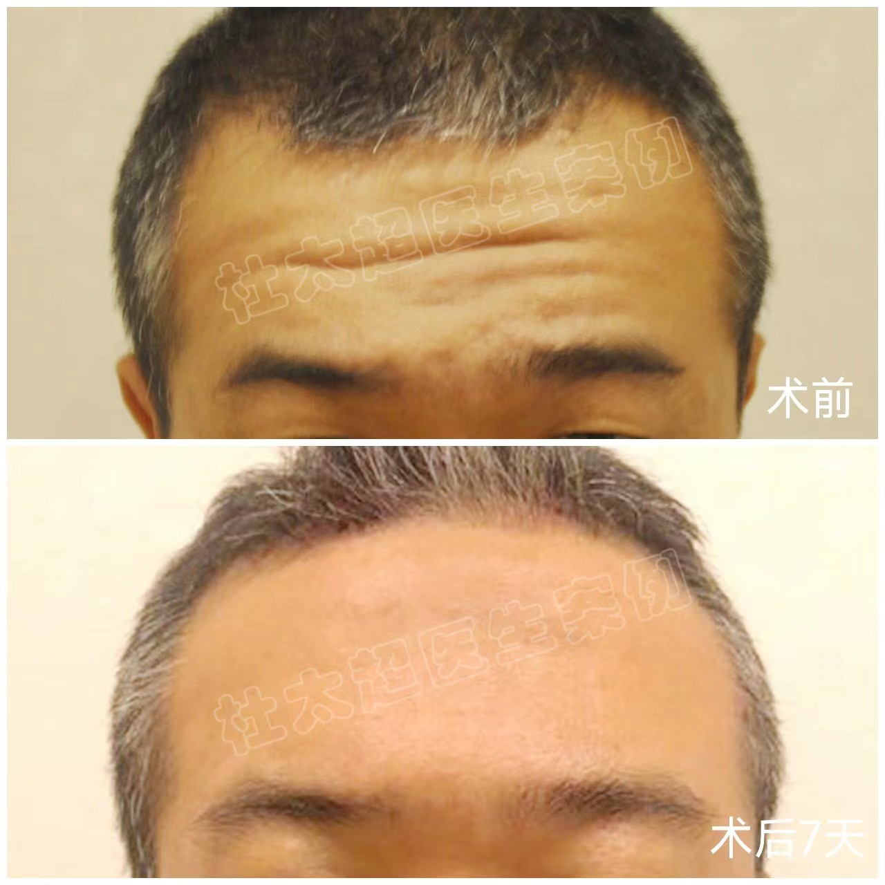 川字纹去除多少钱？不同案例分享效果