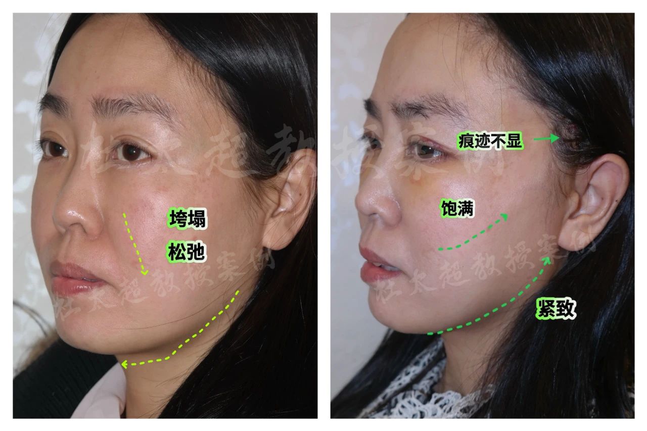 拉皮手术痕迹明显吗?一个透明人的霸道逆袭,来自43岁的华丽转身。 拉皮手术痕迹明显吗?一个透明人的霸道逆袭,来自43岁的华丽转身。