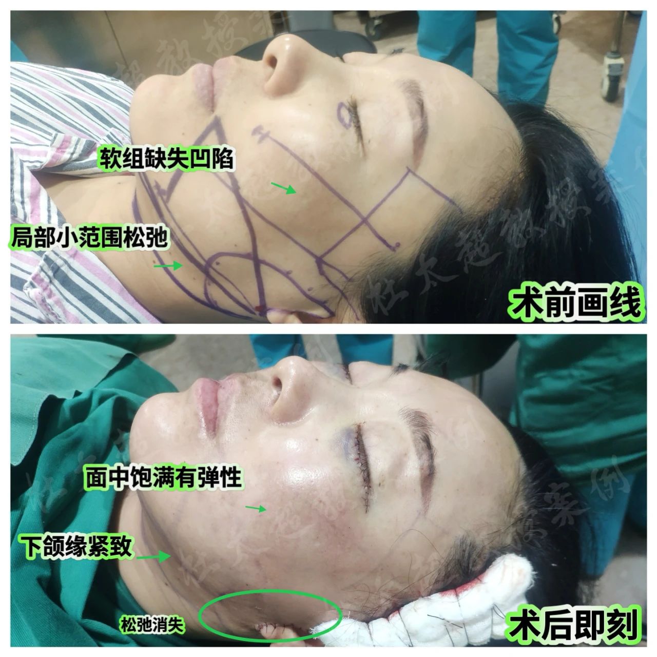 重获新生的惊艳转变！看43岁女美人如何通过拉皮手术反转人生！