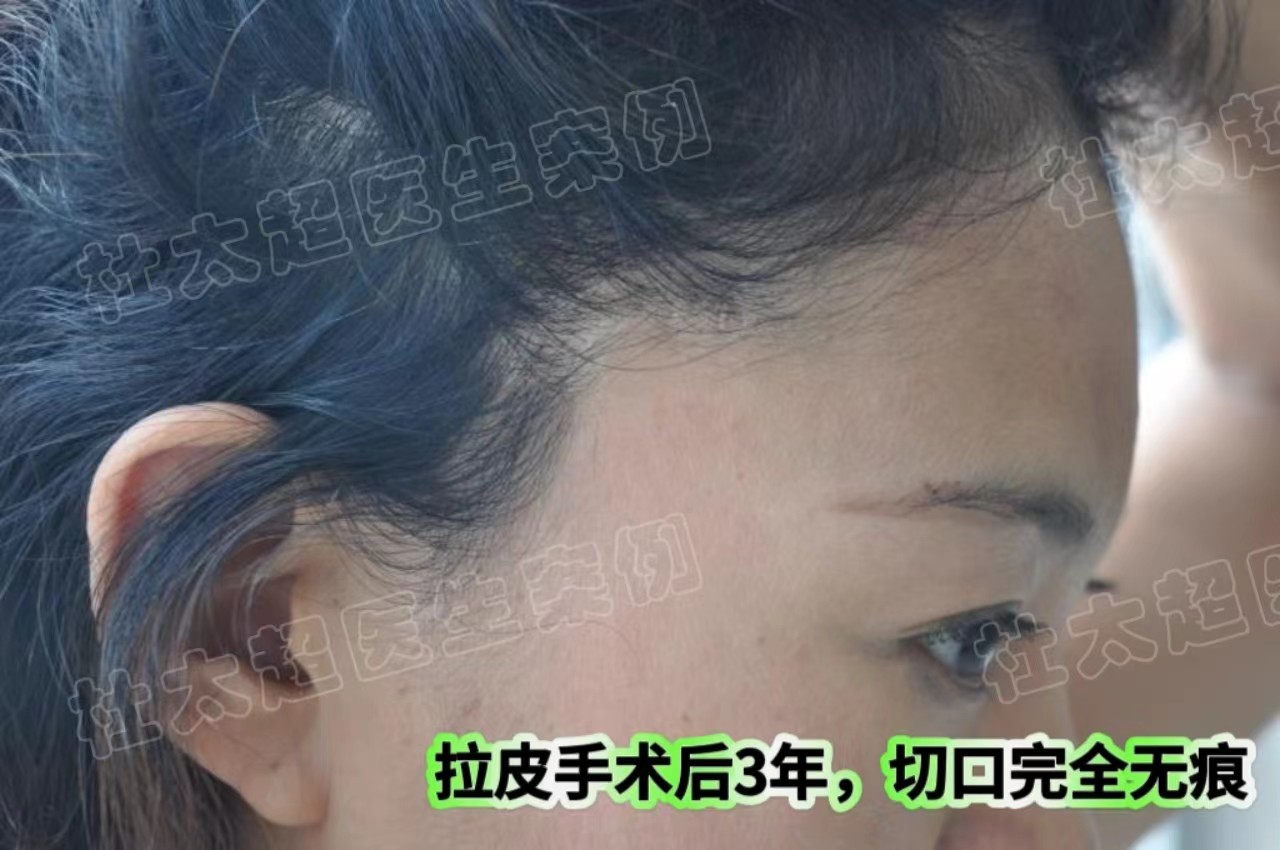 杜太超教授：我做拉皮必须要实现的3个目标！