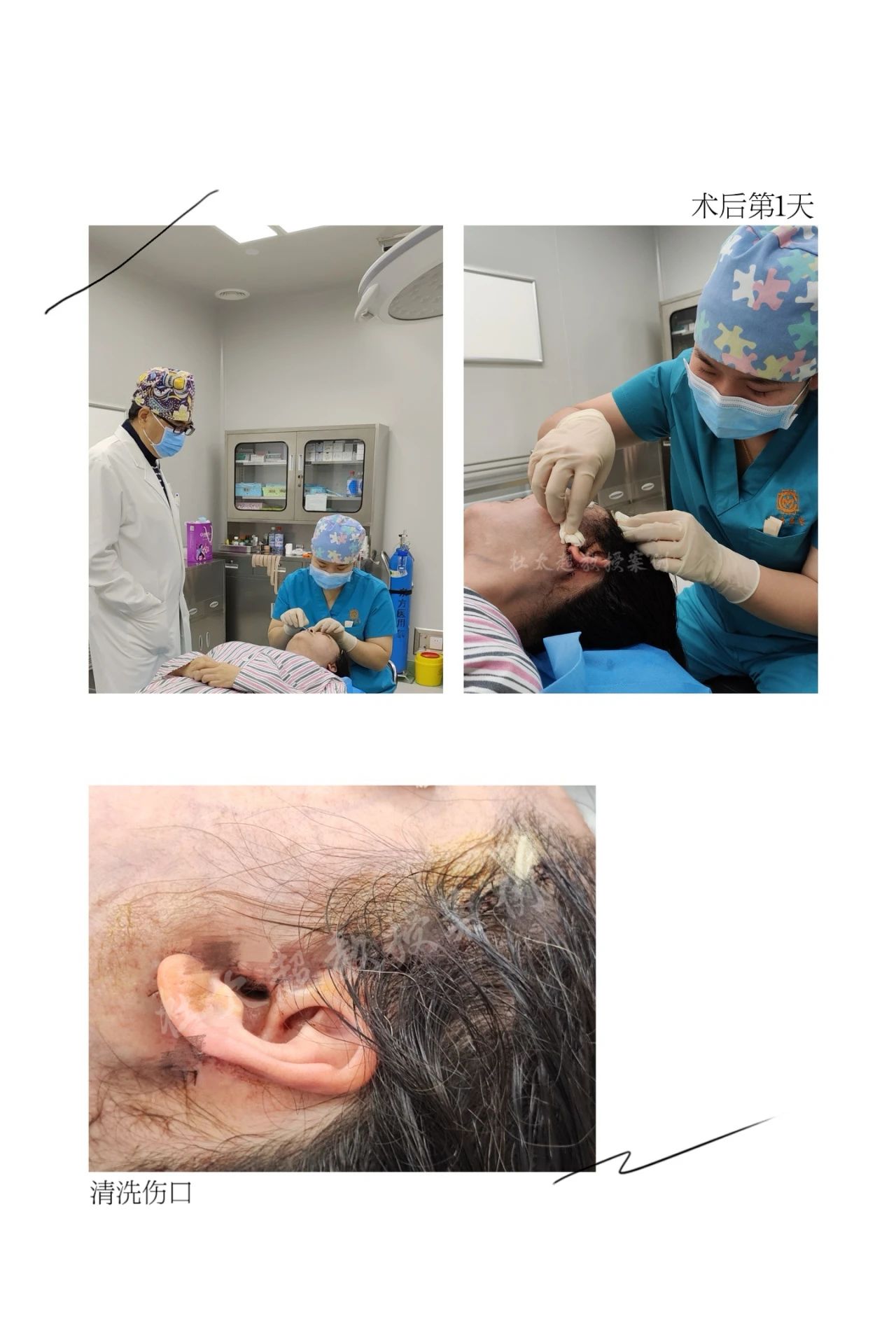 拉皮手术那么可怕吗？47岁从失落到重生，拉皮手术给我带来的不一样体验！