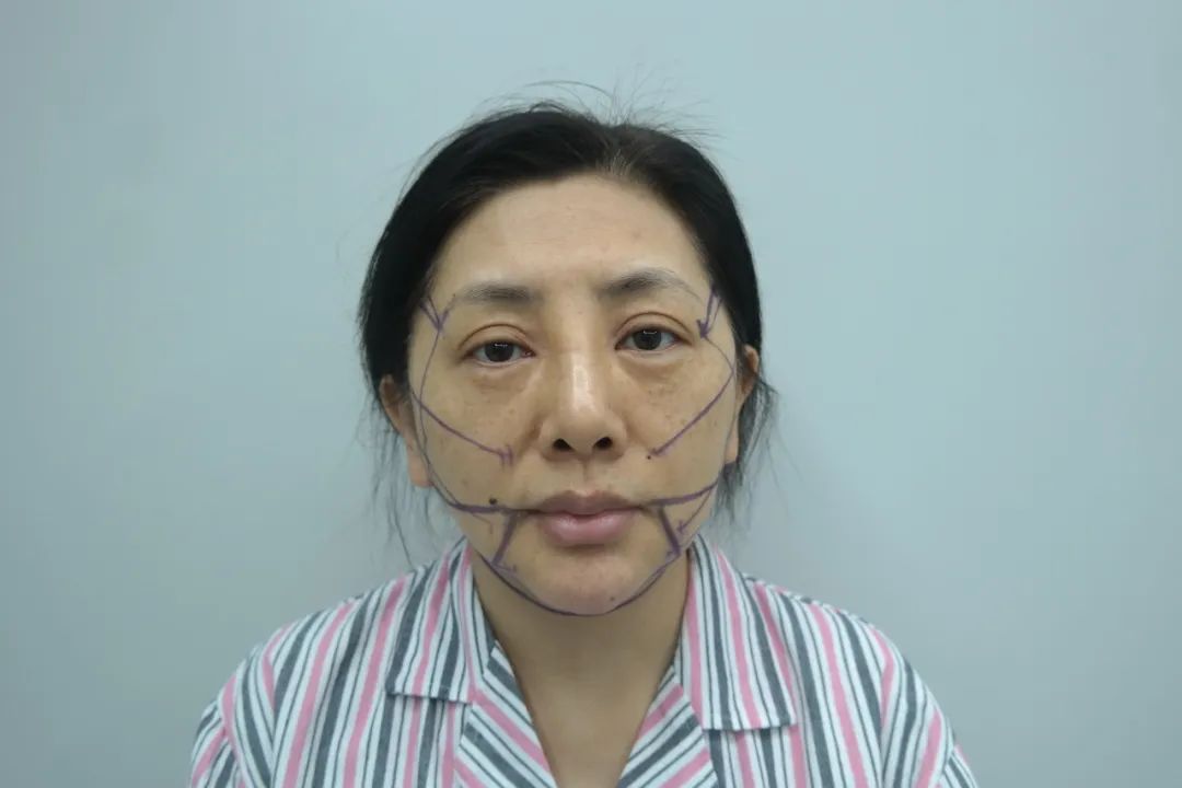 拉皮手术恐怖吗?旧的不去,新的不来,49岁直面拉皮手术,效果太惊艳了! 拉皮手术恐怖吗?旧的不去,新的不来,49岁直面拉皮手术,效果太惊艳了!