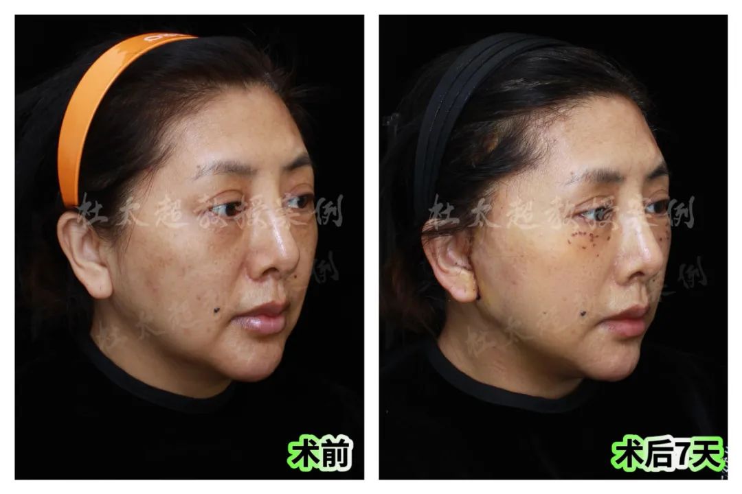 拉皮手术恐怖吗?旧的不去,新的不来,49岁直面拉皮手术,效果太惊艳了! 拉皮手术恐怖吗?旧的不去,新的不来,49岁直面拉皮手术,效果太惊艳了!