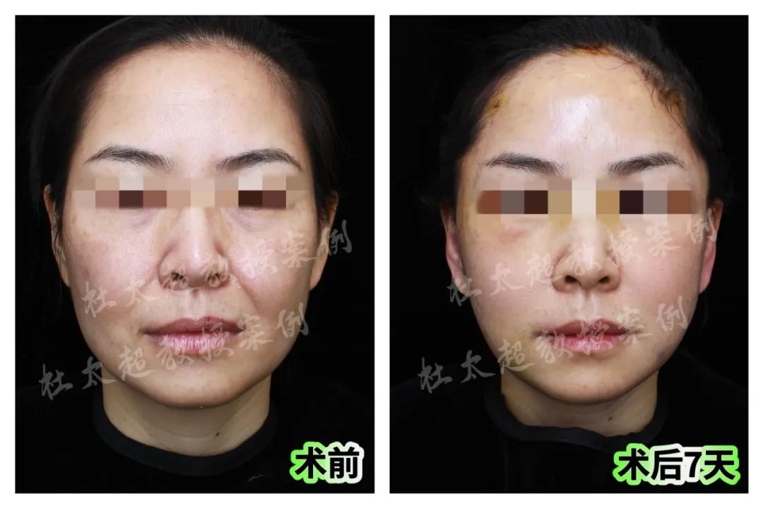 轻易别尝试拉皮手术!48岁惊艳打破传统枷锁! 轻易别尝试拉皮手术!48岁惊艳打破传统枷锁!