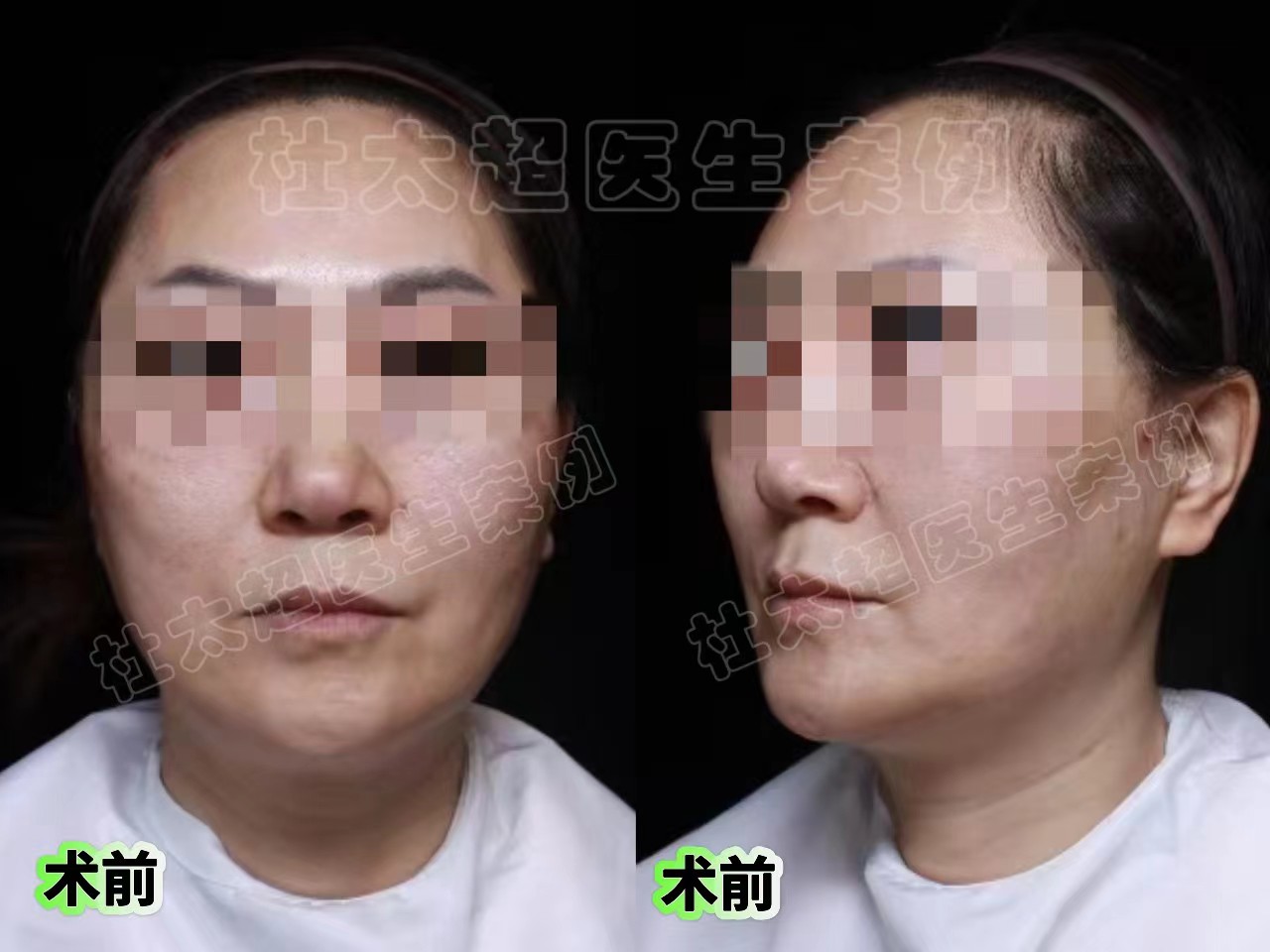 51岁姐姐不服老，挑战拉皮手术，术后恢复惊为天人！