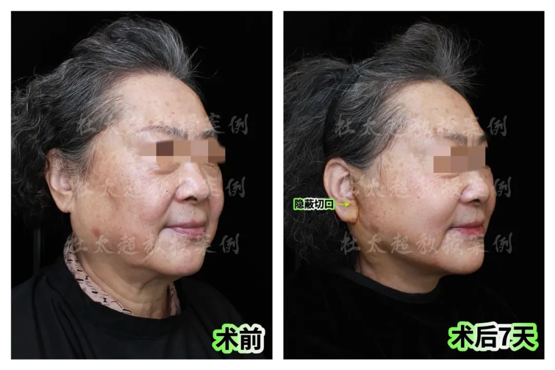 71岁高龄翻天覆地的优雅逆袭，这样的拉皮效果你们看值吗？