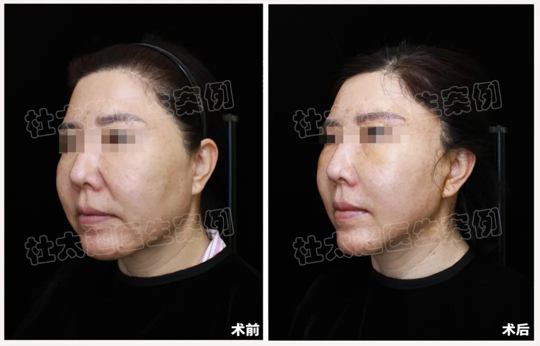 50岁辣妈草率还是大意？冒险进行瞬间拉皮手术，效果让人太惊讶了！