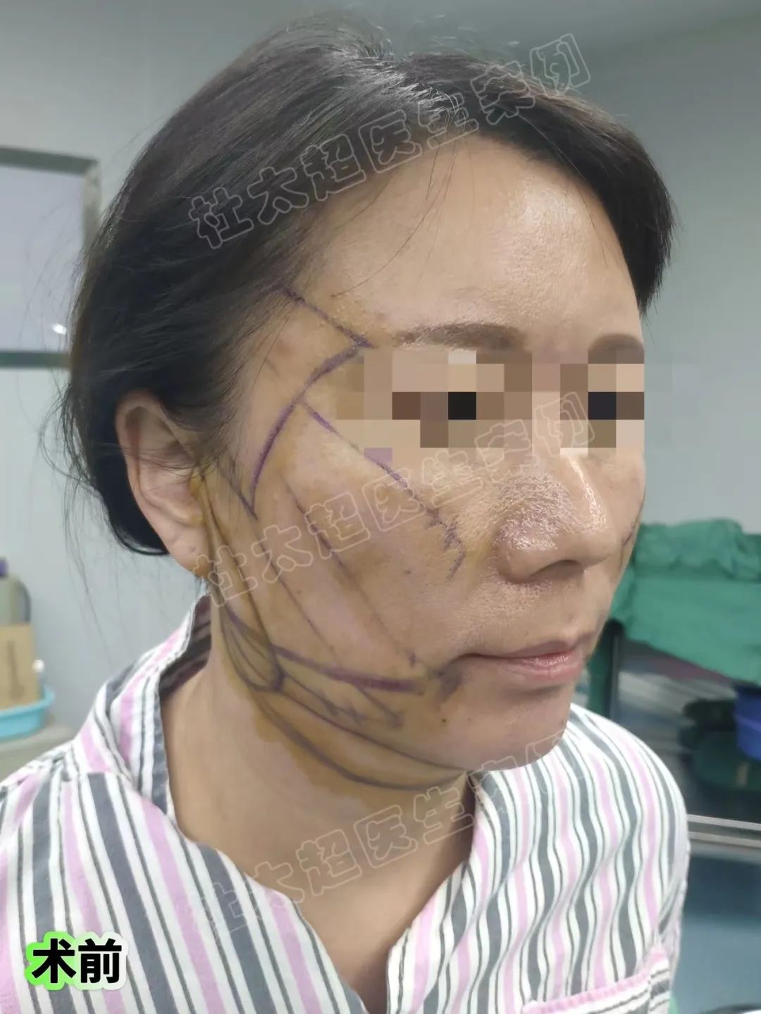 想做拉皮，功课了1年，跟踪了19位真人案例，最终成功逆袭！