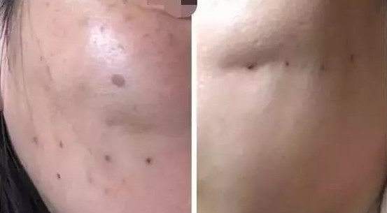 为什么线雕臭名远扬，拉皮手术却风生水起？