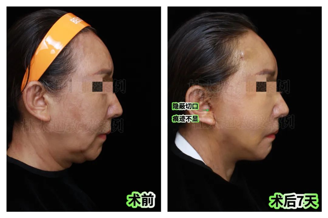 58岁怀揣着对年轻态的执着追求,拉皮手术后让人惊呆了! 58岁怀揣着对年轻态的执着追求,拉皮手术后让人惊呆了!