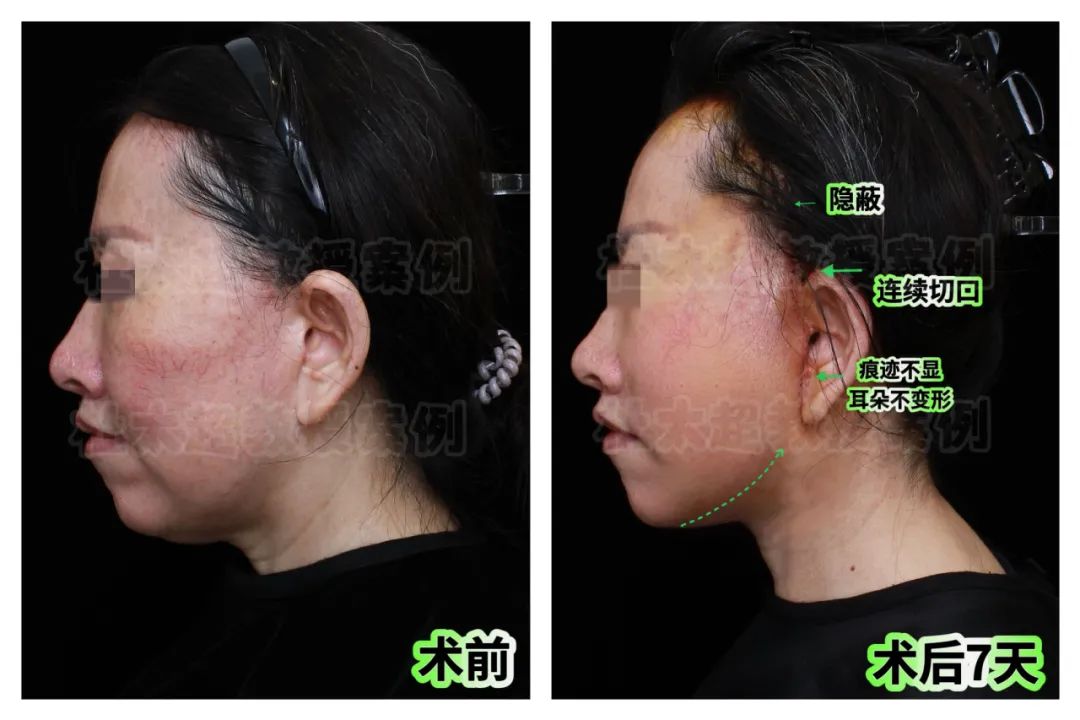 惊天逆袭！引人注目！58岁女士拉皮后感叹效果为何如此惊艳！