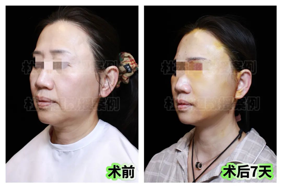 59岁高要求女士，跨越万里从海外归国，专程接受拉皮手术，一试效果令人惊艳！