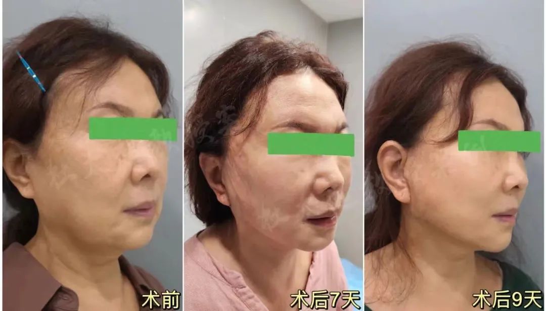 68岁拉皮手术第9天，亲身经历分享，效果超乎预期！