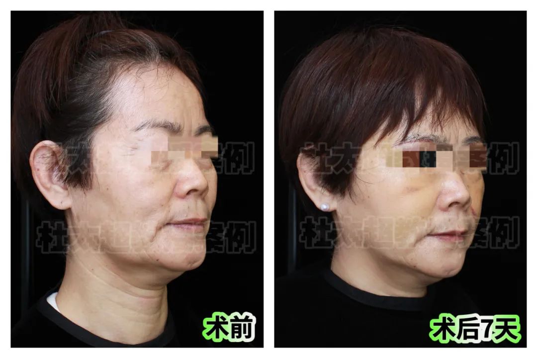 57岁抗击衰老，惊叹他的技艺堪比整形界的“魔术师”！