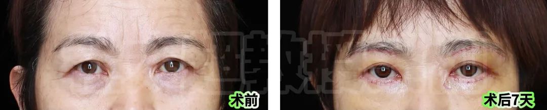 57岁抗击衰老，惊叹他的技艺堪比整形界的“魔术师”！