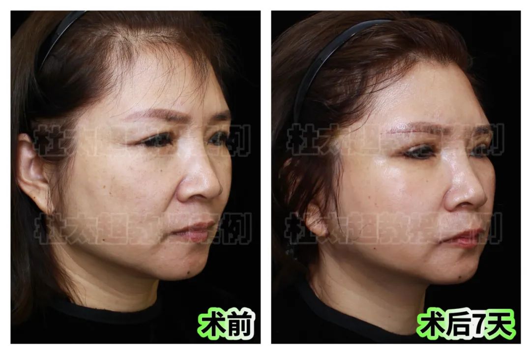 拉皮手术后遗症多？51岁拉皮手术后逆风翻盘，用行动打脸！