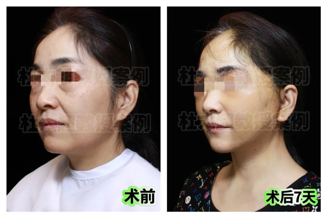 拉皮手术的风险太害怕了?!50岁焦虑者揭秘拉皮手术全过程! 拉皮手术的风险太害怕了?!50岁焦虑者揭秘拉皮手术全过程!