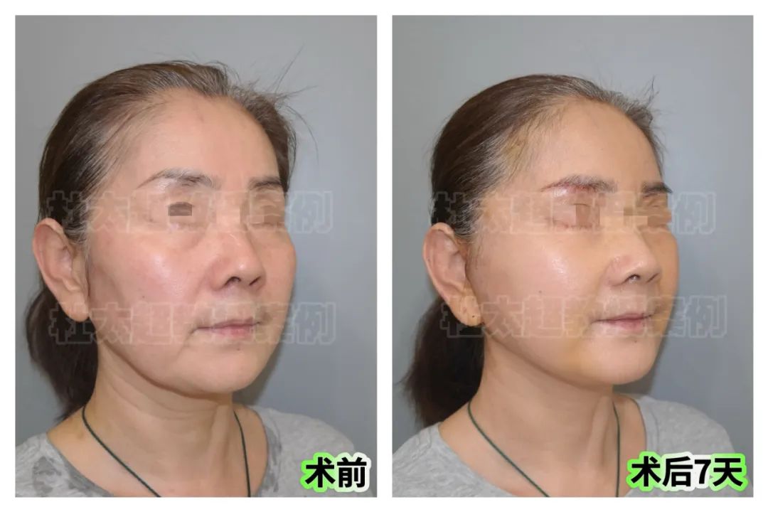 为婚礼拉皮，60岁阿姨太拼了！这样的年轻化你们看值吗？