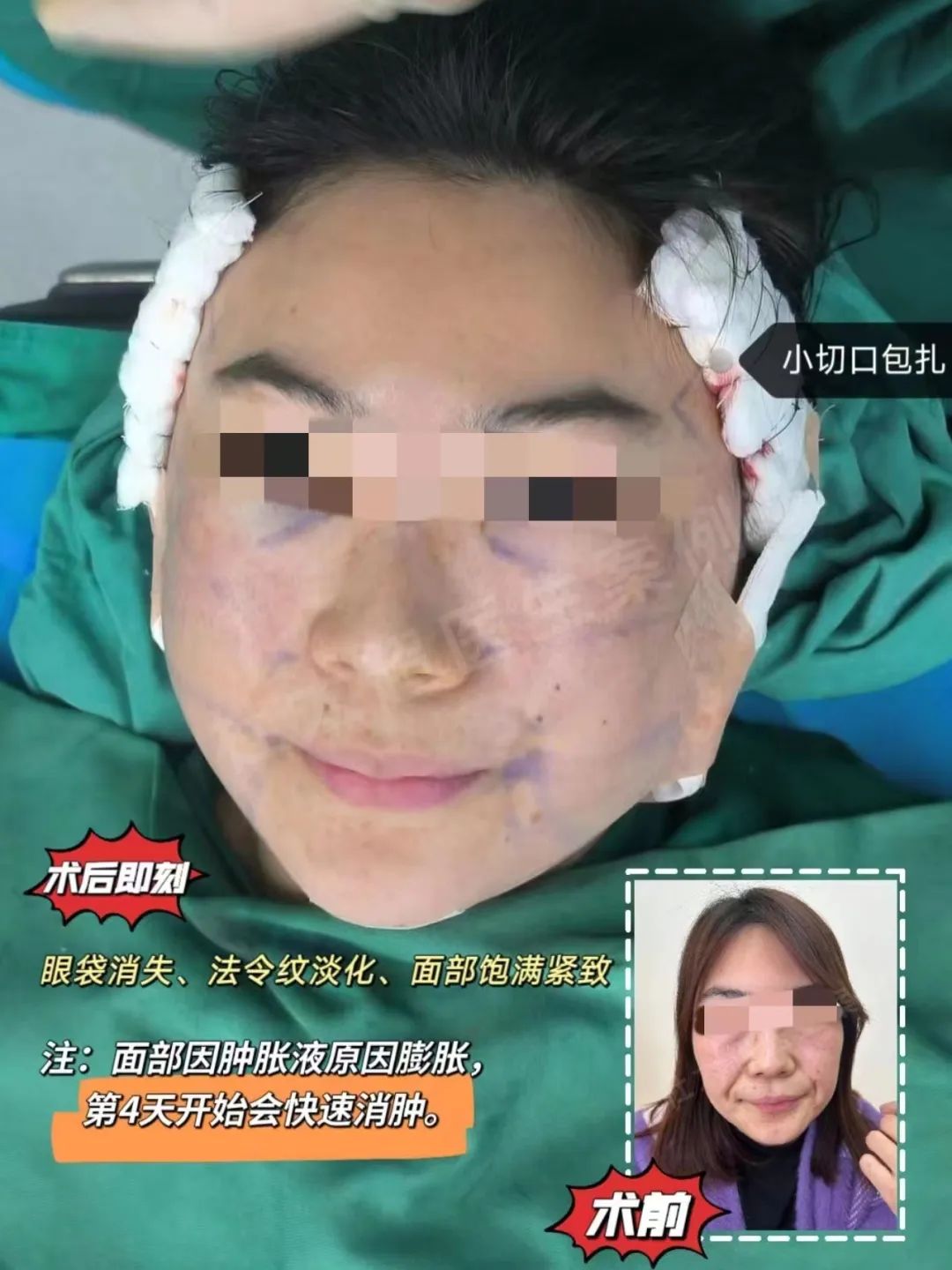 关注12年，23岁就研究拉皮的她，直呼这样的拉皮让她太意外了！