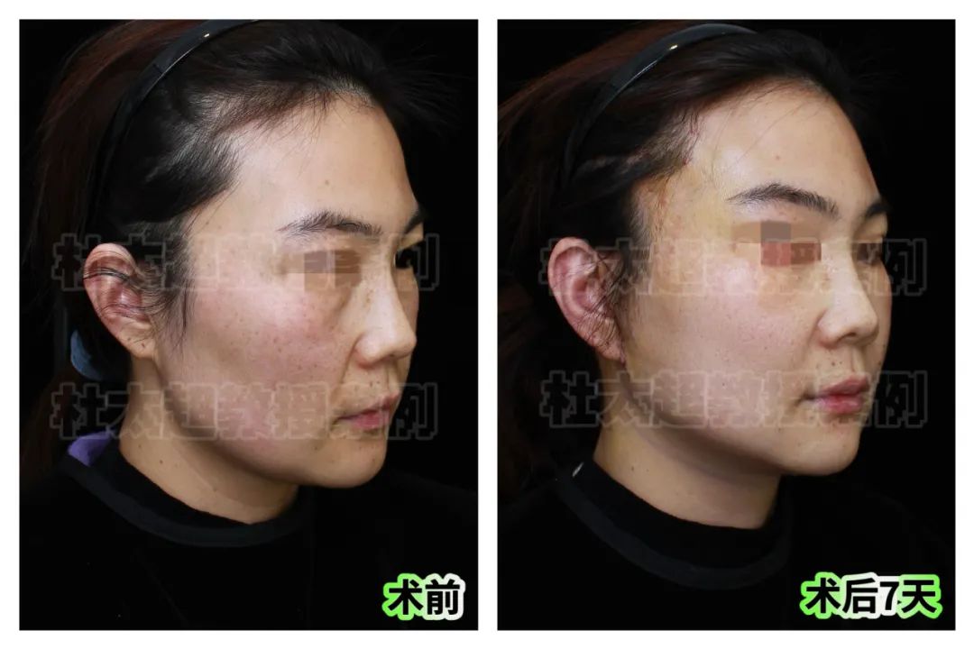 关注12年，23岁就研究拉皮的她，直呼这样的拉皮让她太意外了！