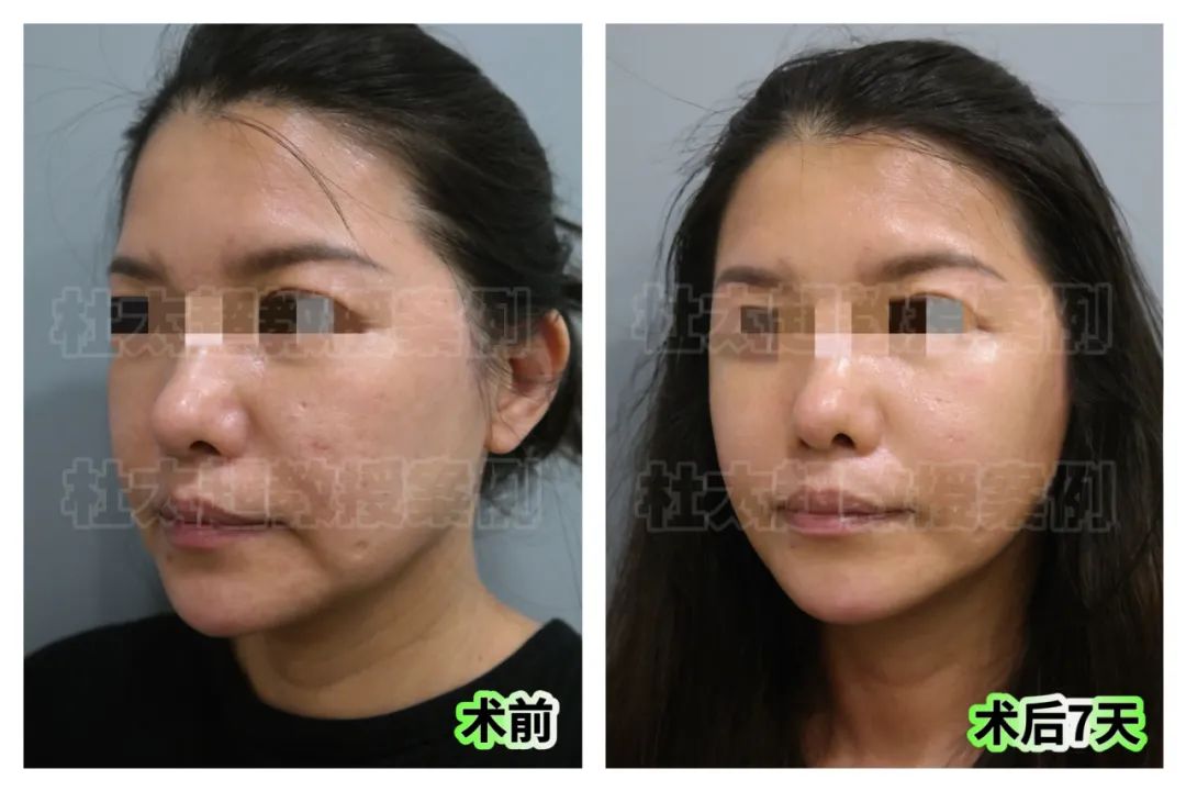 太逆天了!50岁“叛逆少女”在闺蜜的劝说下选择caw小切口拉皮!其效果不敢想象! 太逆天了!50岁“叛逆少女”在闺蜜的劝说下选择caw小切口拉皮!其效果不敢想象!