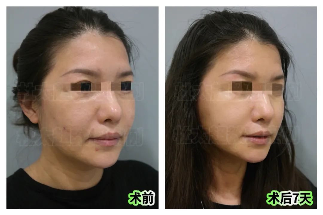 太逆天了!50岁“叛逆少女”在闺蜜的劝说下选择caw小切口拉皮!其效果不敢想象! 太逆天了!50岁“叛逆少女”在闺蜜的劝说下选择caw小切口拉皮!其效果不敢想象!