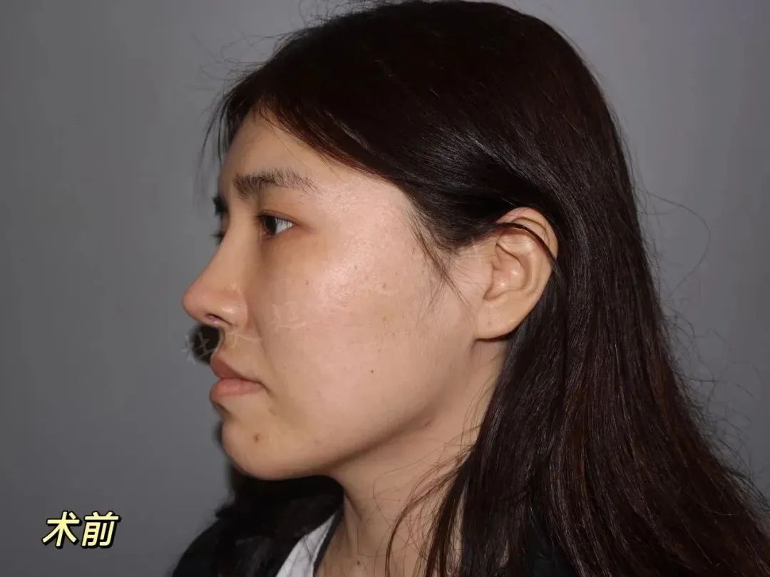 20多岁就做拉皮？这样的刺激体验真的值得吗？