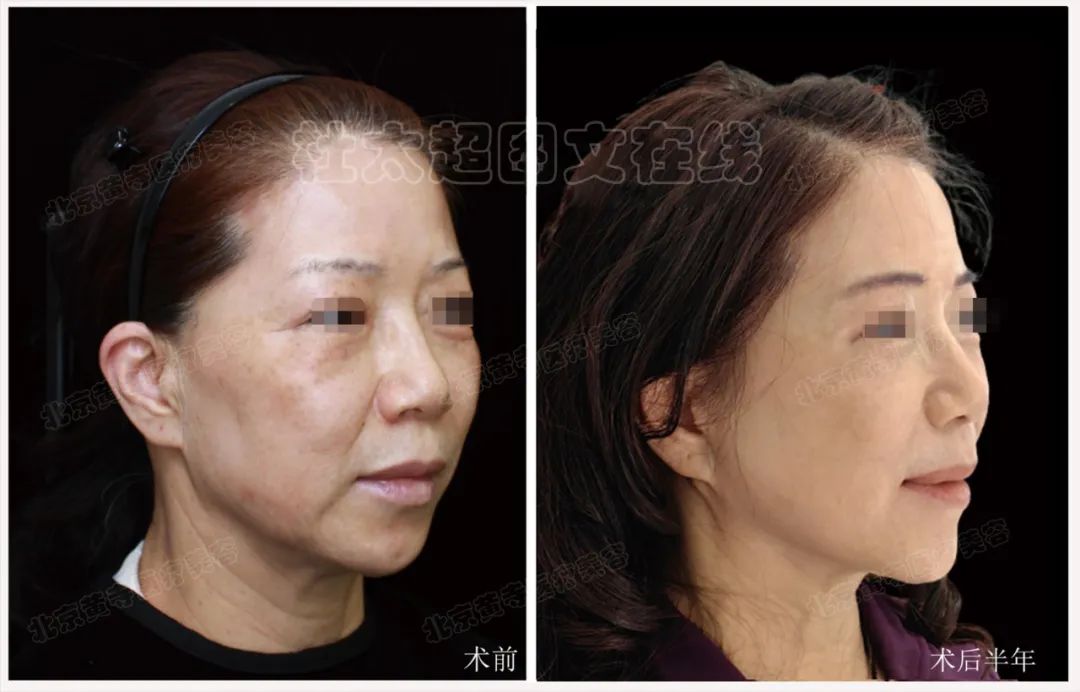 拉皮手术半年后分享！从手术床到故乡的疯狂路程告诉你，感恩不会过时！