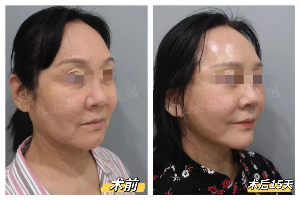 60岁求美者面部松弛下垂，做拉皮提升改善，术后15天真实感受反馈！