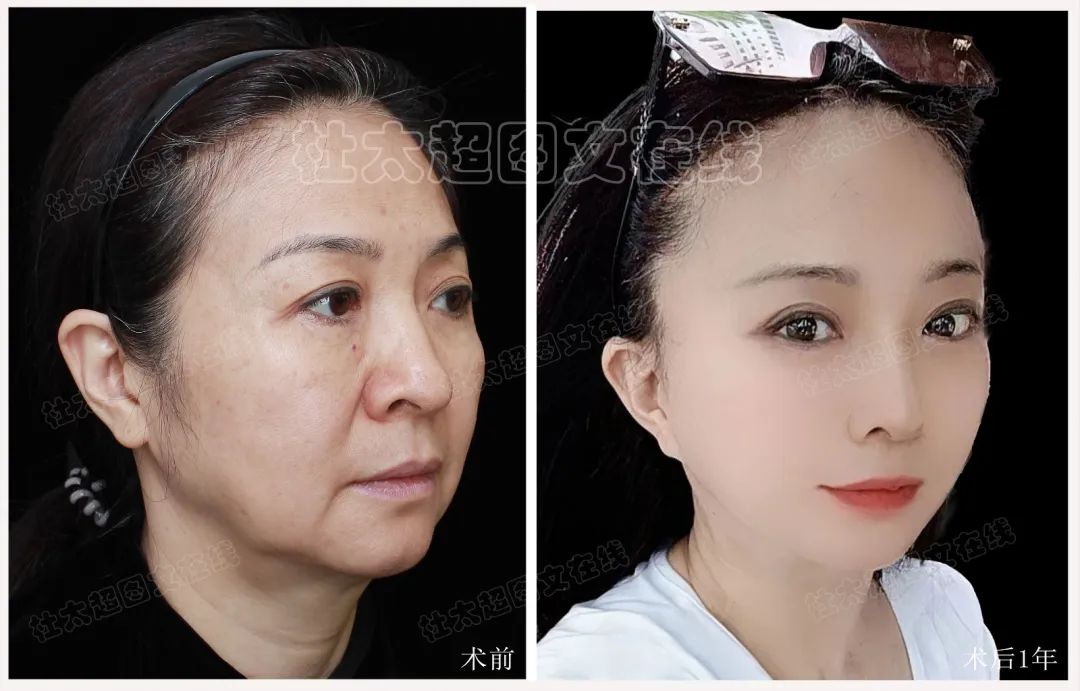 从"复仇者"到"青春少女"：一位五十多岁女性拉皮手术一年的逆袭分享！