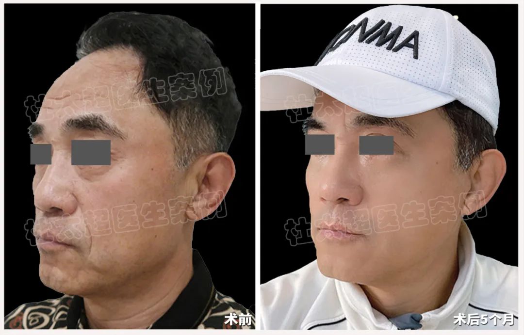 63岁男士“老当益壮”，用拉皮手术开启了他的新式生活！