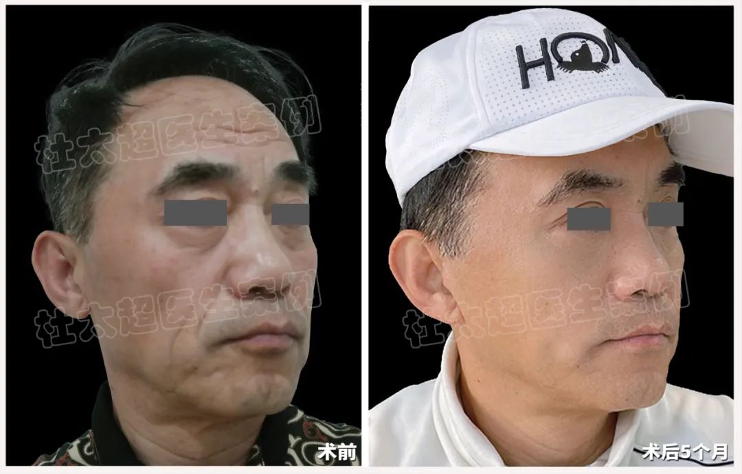 63岁男士“老当益壮”，用拉皮手术开启了他的新式生活！