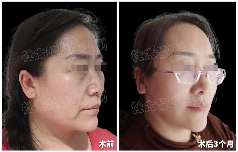 58岁的她如何偷偷回春？拉皮手术3个月后发生翻天覆的变化！