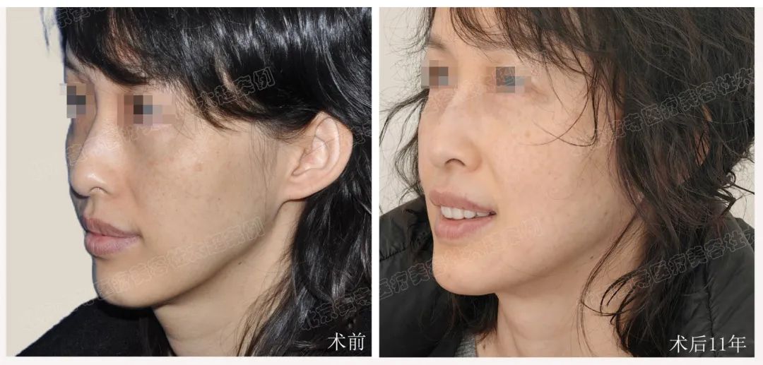 拉皮手术后11年“返场”，她直呼这样的效果是意料之外的！