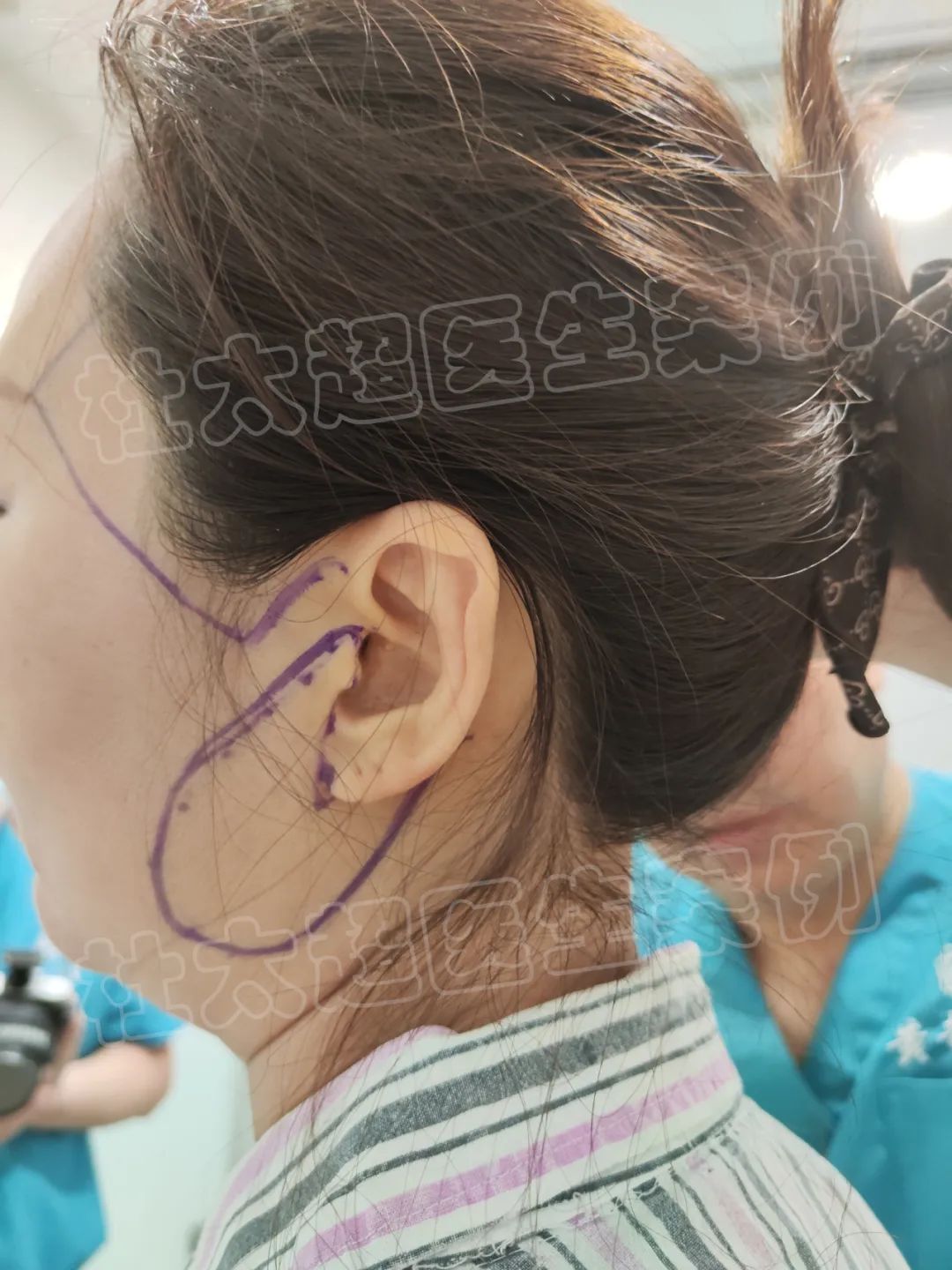 效果令人惊艳！历经25年再一次选择走进黄寺医院，接受拉皮手术。