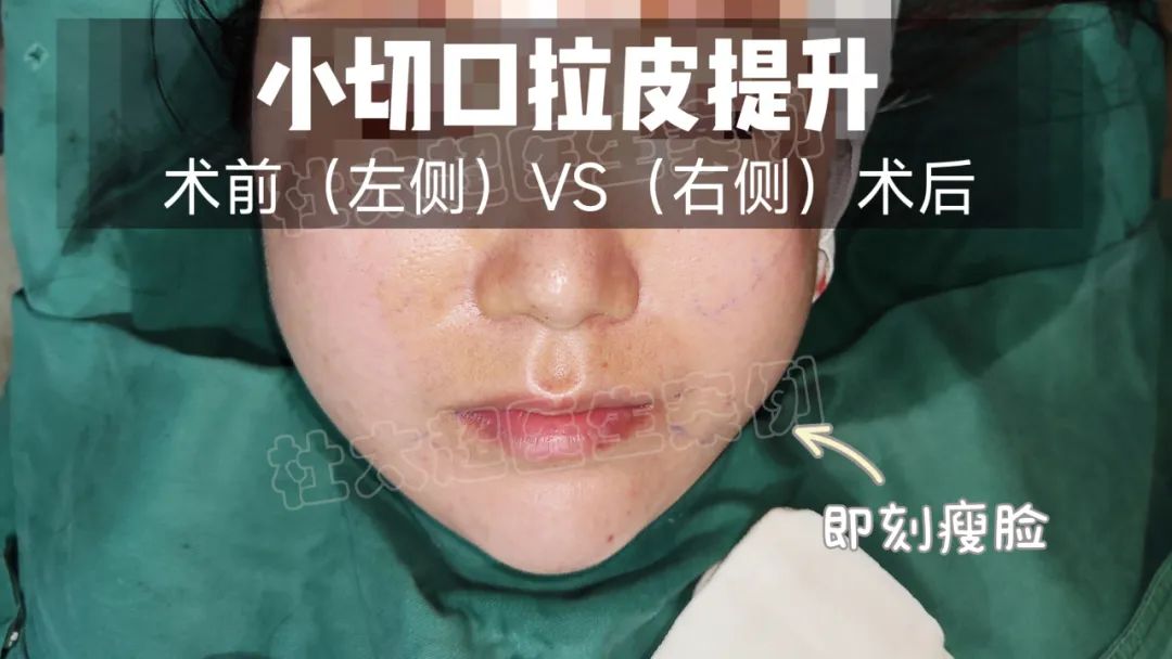 效果令人惊艳！历经25年再一次选择走进黄寺医院，接受拉皮手术。