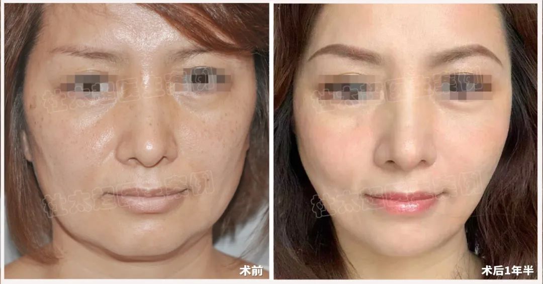 拉皮手术不恐怖！谁说40+的女人不配享受这样的美丽！