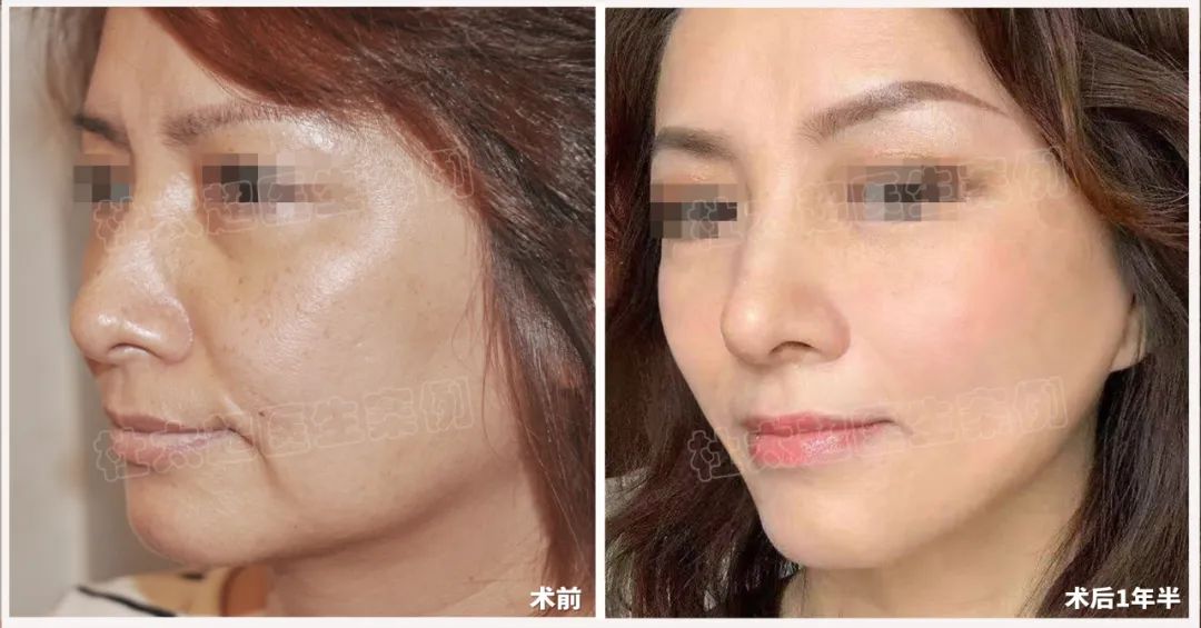 拉皮手术不恐怖！谁说40+的女人不配享受这样的美丽！