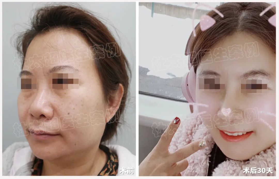 手术前39的她像50岁，经过一场拉皮手术发生改变，效果令人震撼！