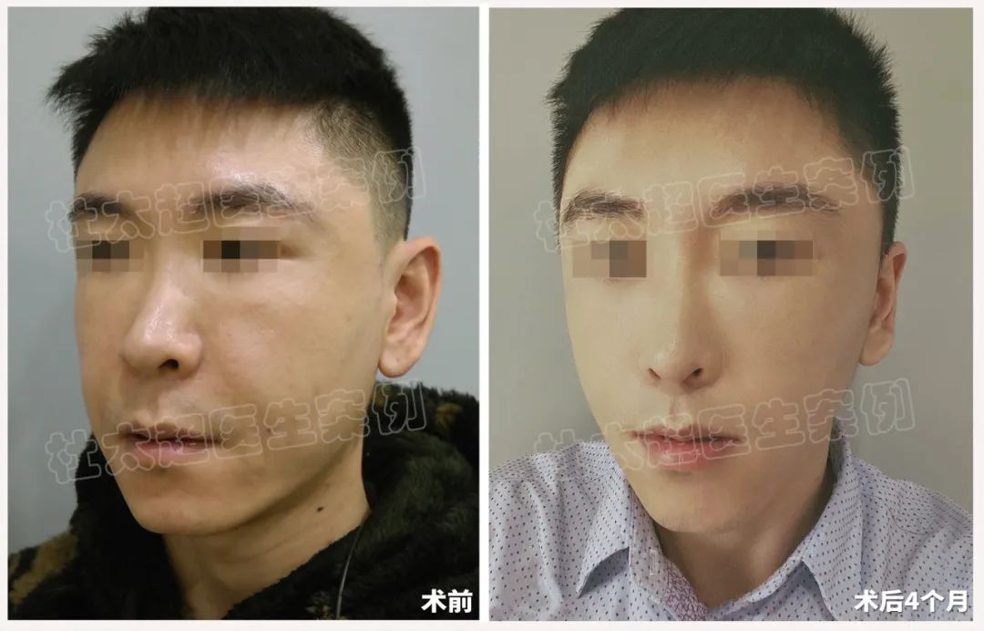 这么年轻就做拉皮？33岁男士拉皮手术术后3年半反馈！