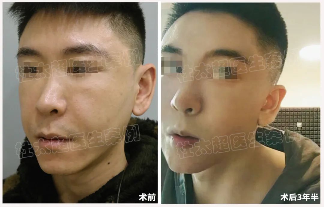 这么年轻就做拉皮？33岁男士拉皮手术术后3年半反馈！