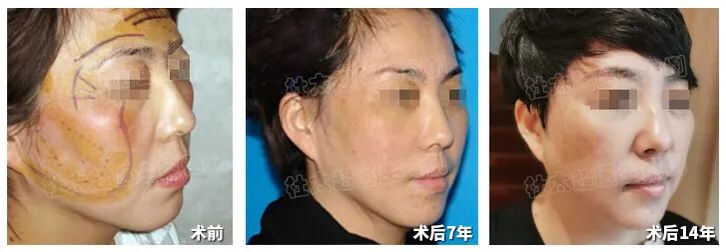 拉皮手术14年不老反而年轻，谁来揭示这个让灵魂都能年轻的秘密？