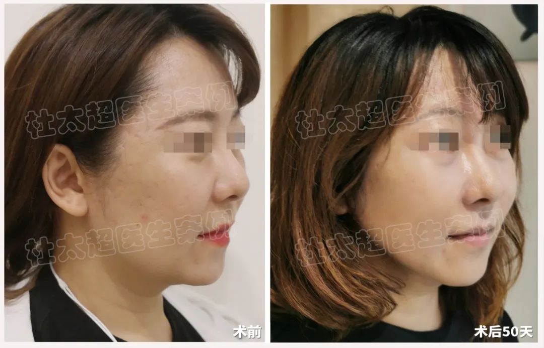 48岁化妆师接受拉皮手术！破茧成蝶，为了更好服务客人，首先要颜值爆表！