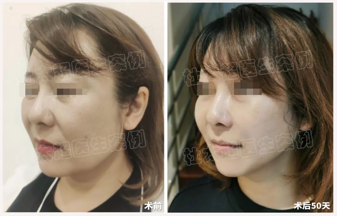 48岁化妆师接受拉皮手术！破茧成蝶，为了更好服务客人，首先要颜值爆表！