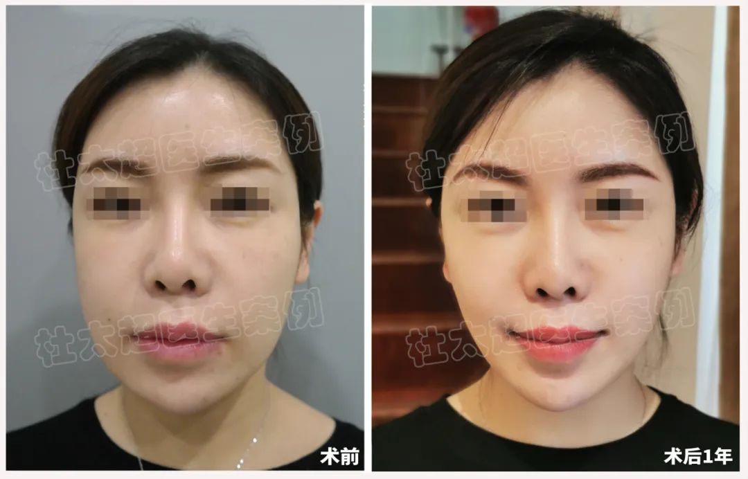 36岁就开始拉皮手术，是否太早啦？