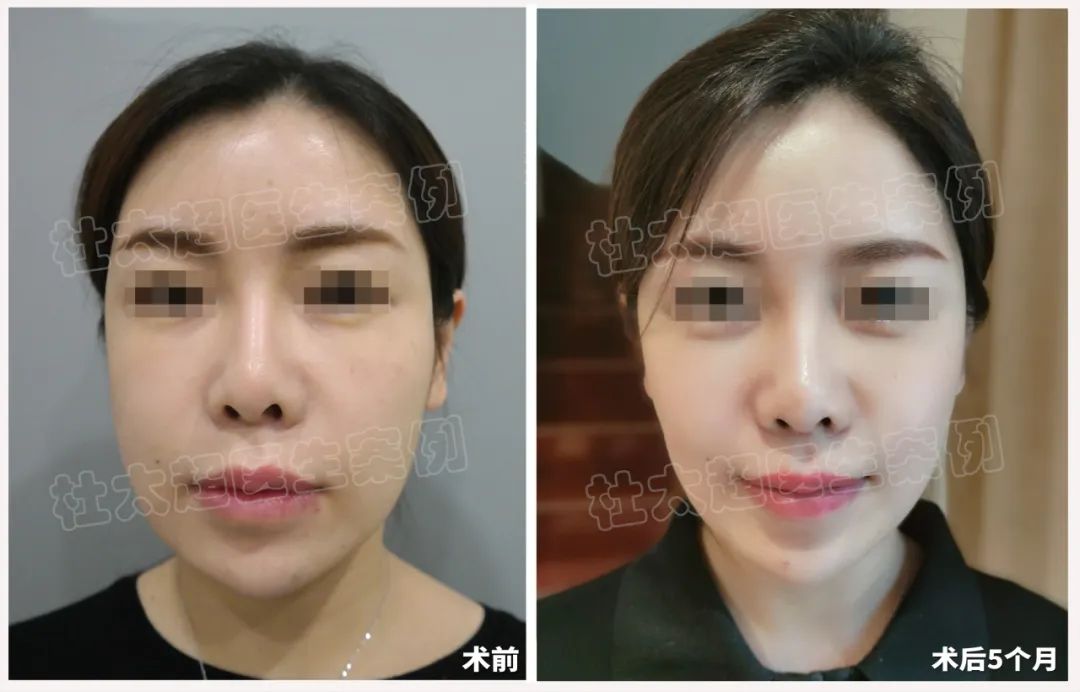 36岁就开始拉皮手术，是否太早啦？