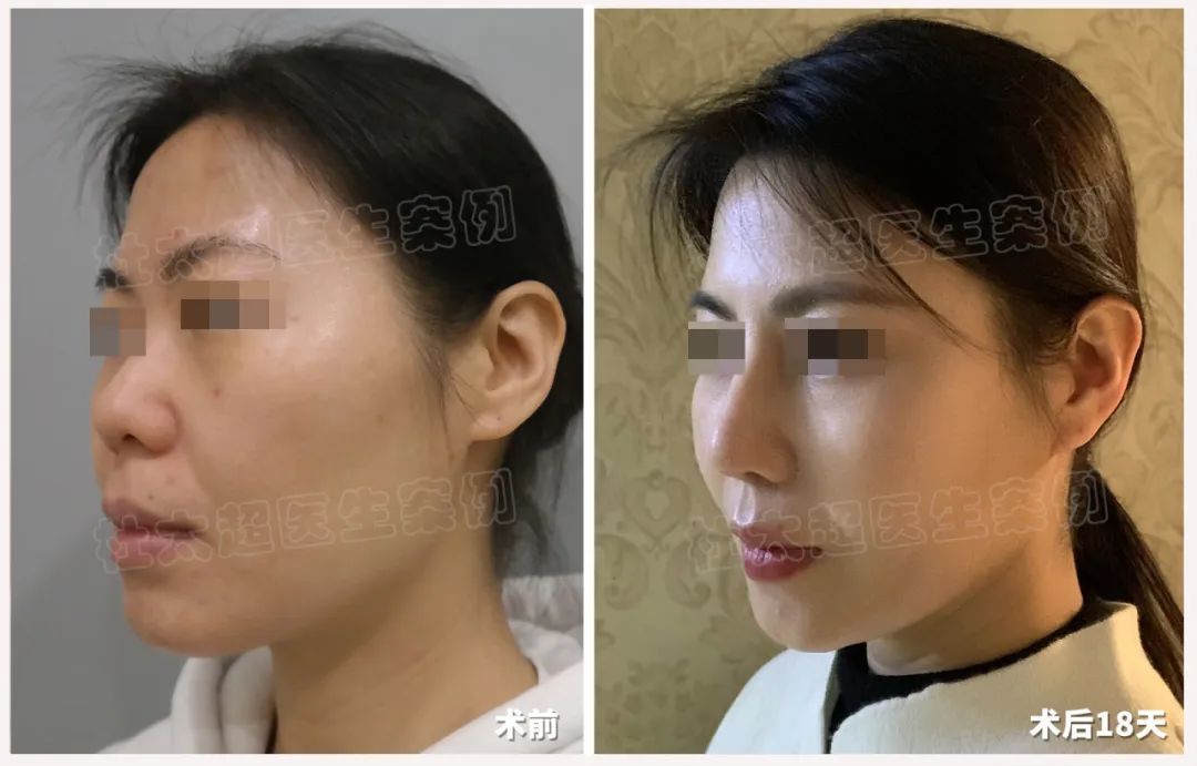 39女设计师个性化重塑之旅，从隆鼻到拉皮她总共做了几步？