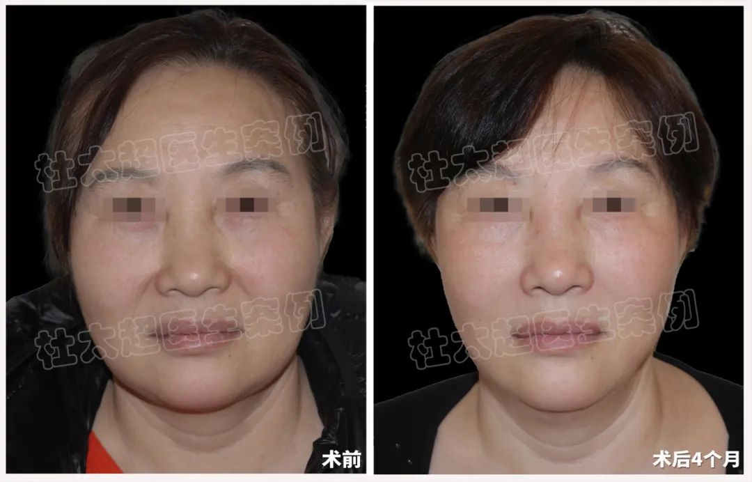 58岁拉皮术后7个月对比，太惊艳了！caw小切口面部提升，让美丽与隐蔽并存。